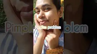 Pimples problem try this hack. #love #song #music #ytshort #facepackforoilyskin #pimplesolution