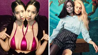 Discover the Unseen World of Siamese Twins: Top 15 Extraordinary Cases!