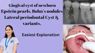 Oral Pathology BDS- Gingival Cyst of Newborn | Epstein Pearls & Bohn's nodules | Lateral Periodontal