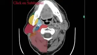 Quiz mode in MedSeg. Deep neck spaces on CT.