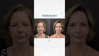 Tired of droopy eyelids? #eyelidlift