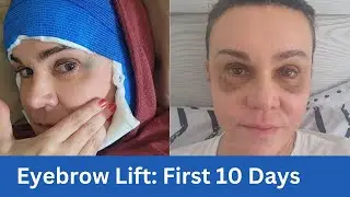 Trichophytic Eyebrow Lift Journey: Tips, Insights, and What to Expect!