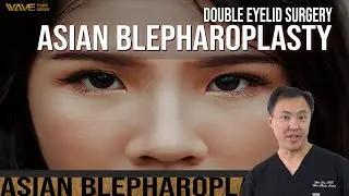 Asian Blepharoplasty! | Wave Plastic Surgery