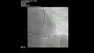 DDDR Pacemaker via Persistent Left Superior Vena Cava | Rare Complete Heart Block Case Explained