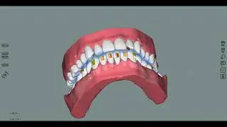 Lower Arch Space Closure