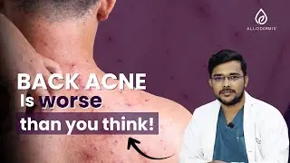 Back Acne Can Cause Permanent Scars! Dermatologist Explains Why