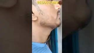 Result Day|Using Man Matters Minoxidil 5% for Beard Growth 🤫#beard |#minoxidil #beardworld