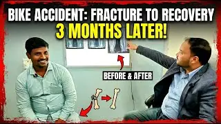 Bike Accident: Fracture To Receivey 3 Month's Leter! ||Dr Prakash Kumar (Siwan, Bihar)