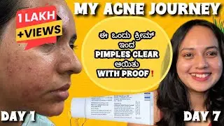 My Acne Journey with Live result⚠️Acne ಇಂದ Suffer ಆಗ್ತಾ ಇರೋರು Must watch this video|Best Acne Cream|