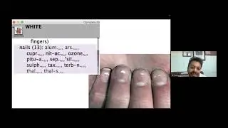 Hands, feet, nails- Observation