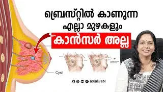 ബ്രെസ്റ്റിൽ കാണുന്ന എല്ലാ മുഴകളും കാൻസർ അല്ല Breast cancer - Symptoms and causes Health Tips