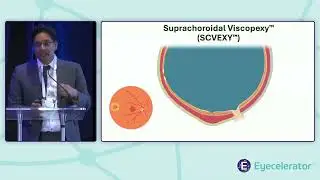 Eyecelerator @ Park City 2025 | Retina Showcase: Dragonfleye Therapeutics Corp