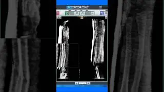Xray Radius fracture ap lateral view💪 #xray #duet #ultrasound #medicalimaging #anatomy