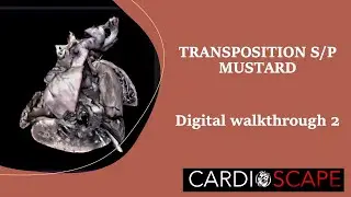 Exploring a rare cardiac specimen! Transposition with Mustard Operation in 3D! Digital walkthrough 2