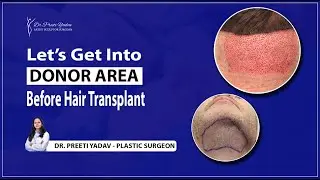 Hair Transplant Donor Area | Harvesting Hair from Beard | Why used Beard Hair