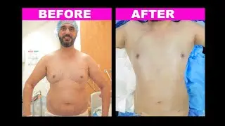 Liposuction in Bellaroma Hospital