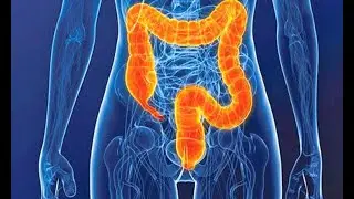 &iquest;Est&aacute; relacionado el microbioma intestinal con el aumento de c&aacute;ncer colorrectal en adultos j&oacute;venes?