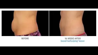 CoolSculpting Orange County at OC Dermatology