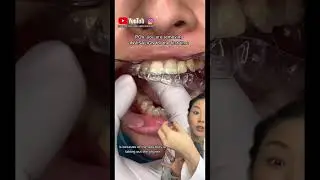 Trick to remove Invisalign. #invisalign #retainers #dentist #braces