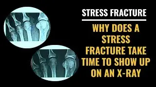 Stress Fracture - Why does a stress fracture take time to show up on an x-ray?
