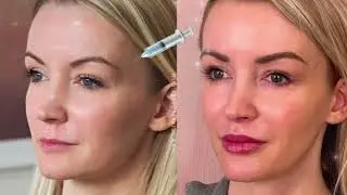 dreamy doll temples 💉 temple filler/augmentation: filled-in feminine temples 💕