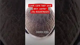 Best Full lace hair patch for natural hair style. | hair patch #hair