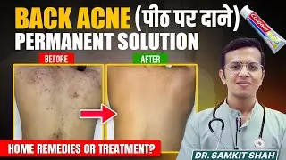 BACK Acne Treatment That REALLY Works