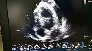 Neuro intervention Internal carotid artery 90%stenosis