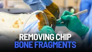 Removing Bone Fragments from a Horse's Knee | Equine Surgery