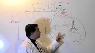 COPD: Lung damage from smoking