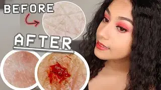 MY 'ALLERGIC TO WATER' SKIN AFTER A BATH *MICROSCOPE FOOTAGE* | Niah Selway