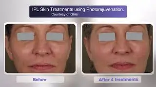 The Lumenis M22 Laser at River Aesthetics