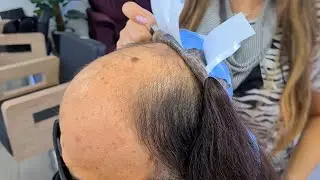 Como eu aplico a Prótese capilar injetada!