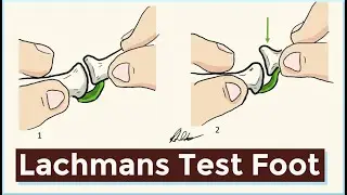 Lachmans Test of the Foot | MTPJ Instability & Frieberg's Disease