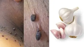 Remove skin tags overnight with toothpaste​ and garlic remedy | Skin tag removal  In 1 Night