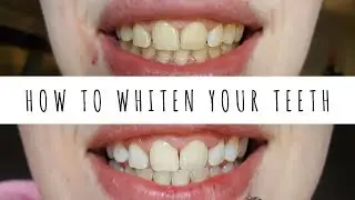 How To Whiten Your Teeth + Giveaway| Jordan Nicola