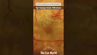 Vogt-Koyanagi-Harada (VKH) disease