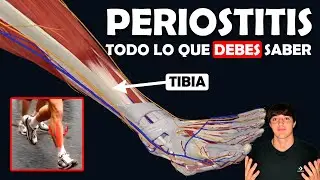 PERIOSTITIS TIBIAL: Su TRATAMIENTO y lo que debes saber