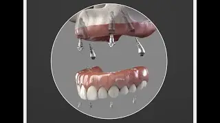 Implantes Dentales Fort Lauderdale