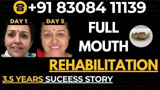 Best Dentist in India: Full Mouth Transformation? 😱 | PreciGem