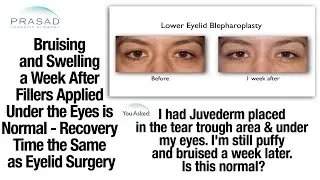 Swelling and Bruising after Cosmetic Filler Application is Part of the Normal Healing Process