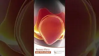Recovery after Knee Replacement | Joseph Greene M.D.