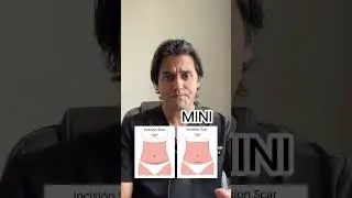 What is a mini tummy tuck? #shortsvideo #shorts #shortsyoutube