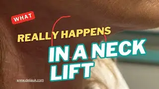 Neck Lift Surgery: EVERYTHING you NEED to know BEFORE surgery in UNDER 8 mins with Dhalia Masud