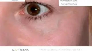 Laser Tattoo Removal Long Island Commack NY