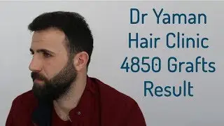 Dr Resul Yaman Hair Clinic - 4850 Grafts Result
