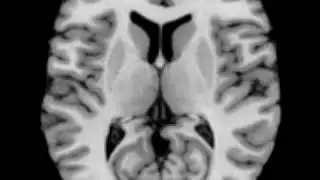 Brain activity during listening to unfamiliar songs (meta-analysis)