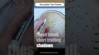 'Snowglobe' Eye Floaters