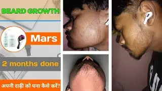 BEARD GROWTH ! (2) months done ✔️ from mars minoxidil ! अपनी दाढ़ी को घना कैसे करें?