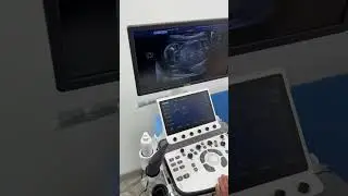 УЗИ аппарат Chison Xbit 80